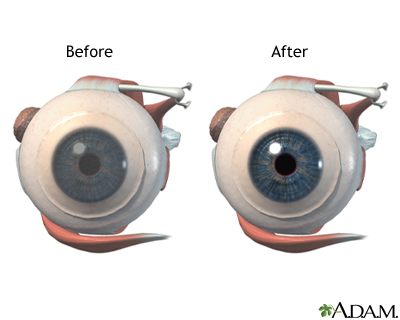 Fuchs Corneal Dystrophy before and after